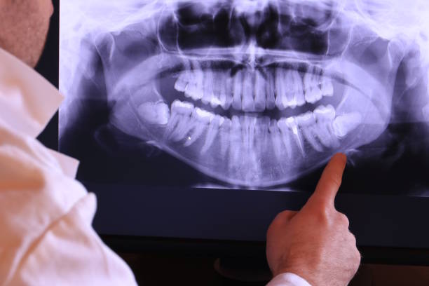 Best Knocked-Out Tooth (Avulsed Tooth) Treatment in Toccoa, GA
