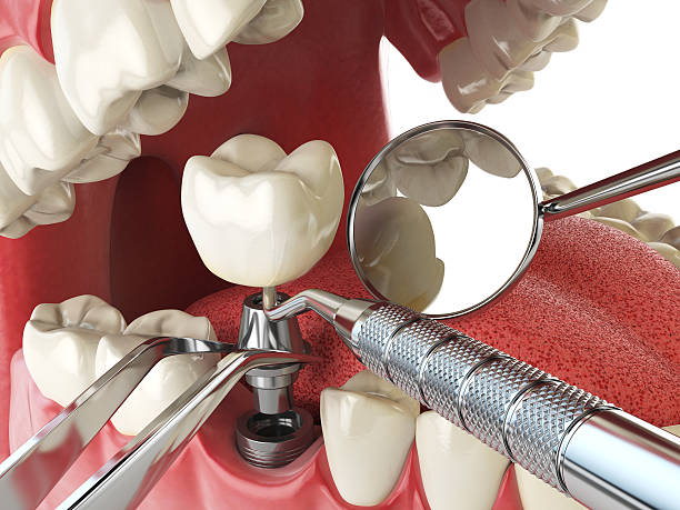 Best Emergency Root Canal Therapy in Toccoa, GA